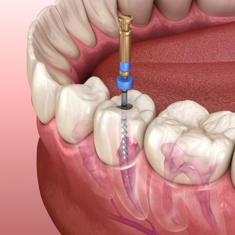 endodoncija