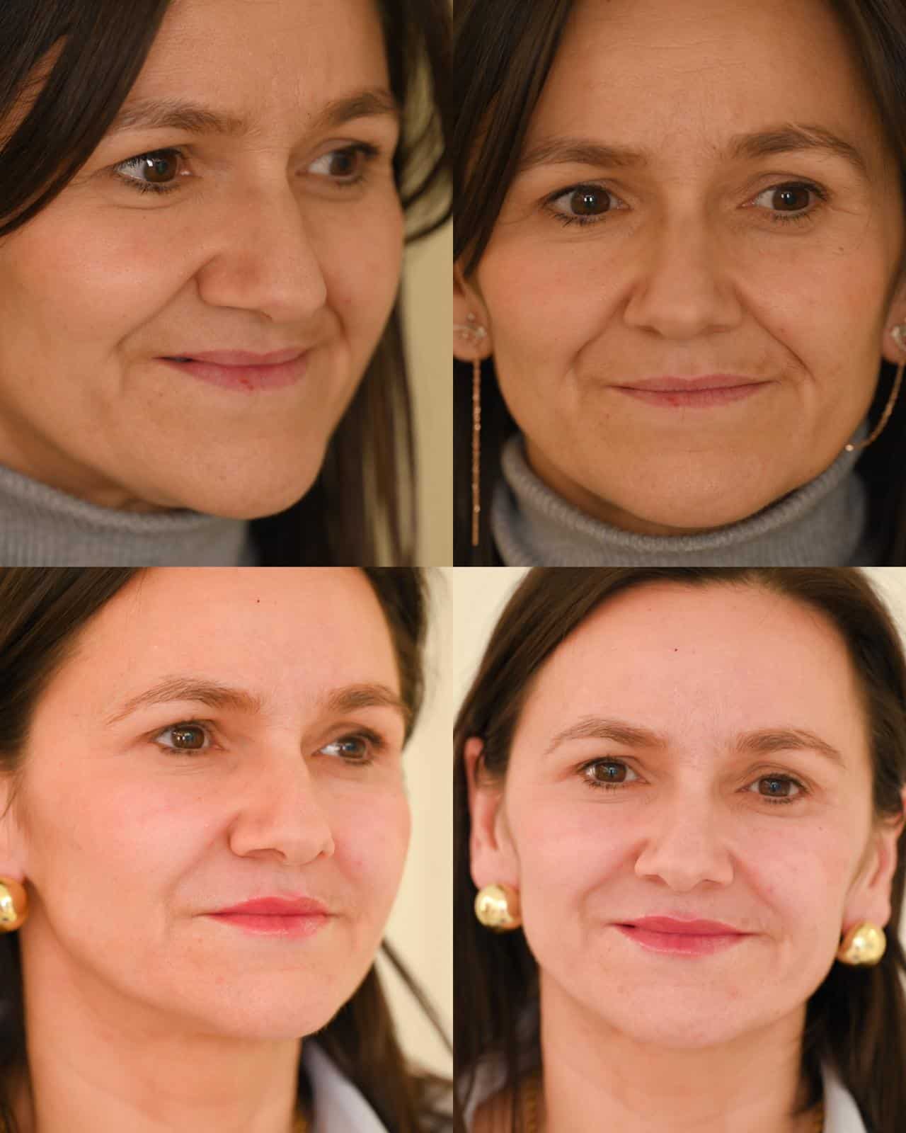 Hijaluronski filer usana, i nazolabijalnih bora