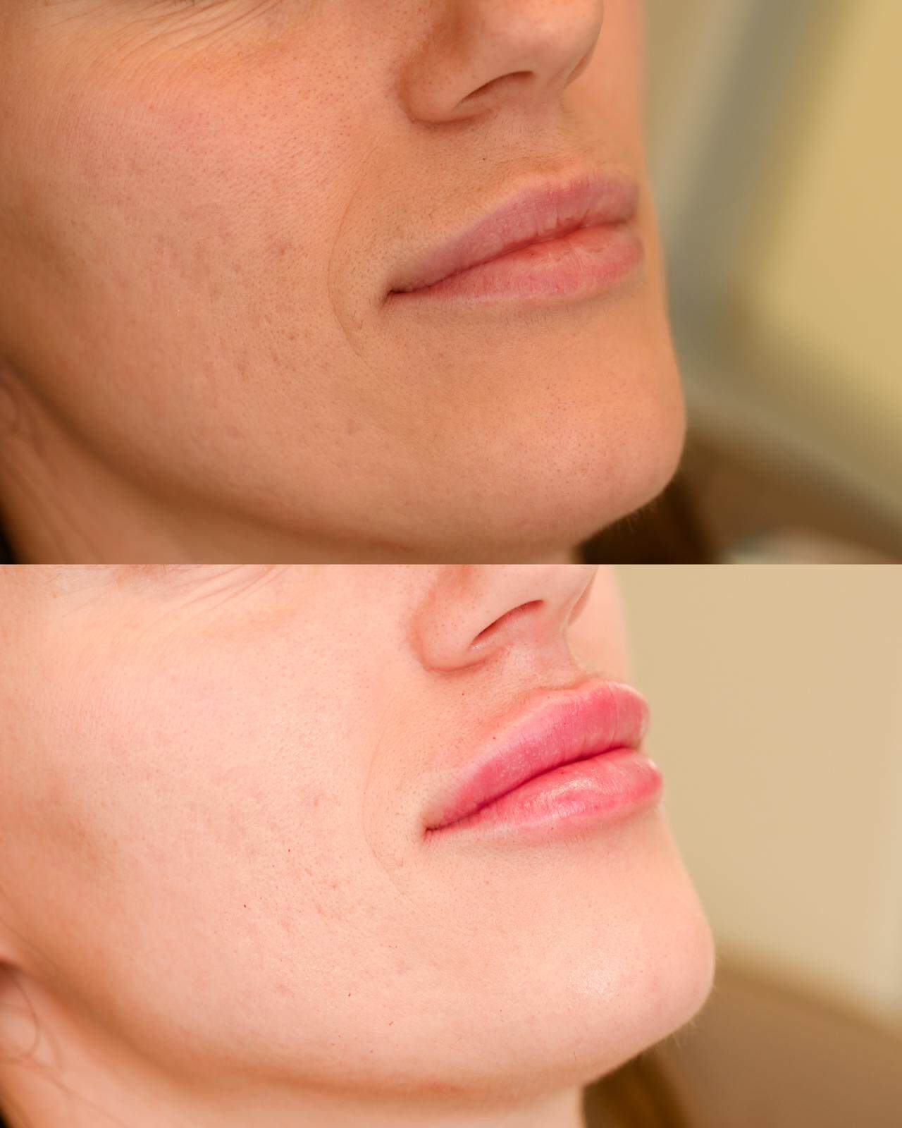 Hijaluronski fileri usana