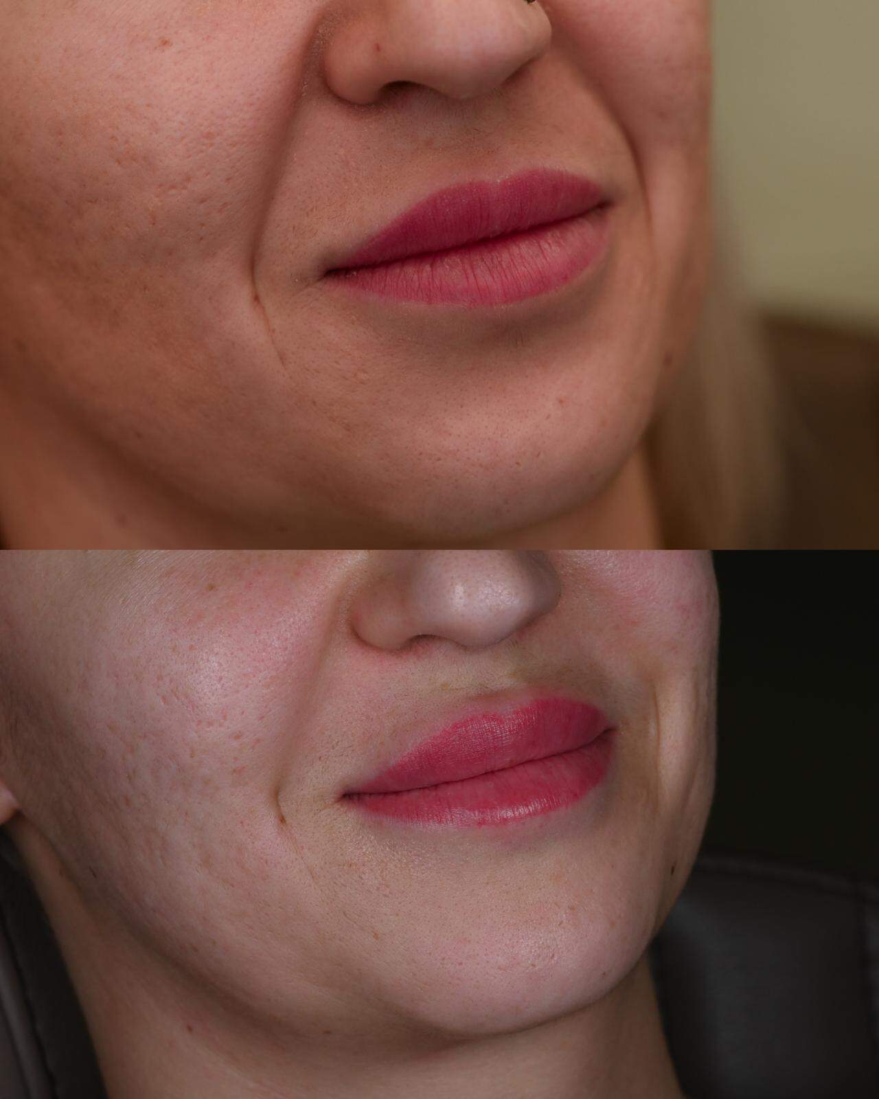 Popunjavanje nazolabijalnih bora, i osvjezavanje usana