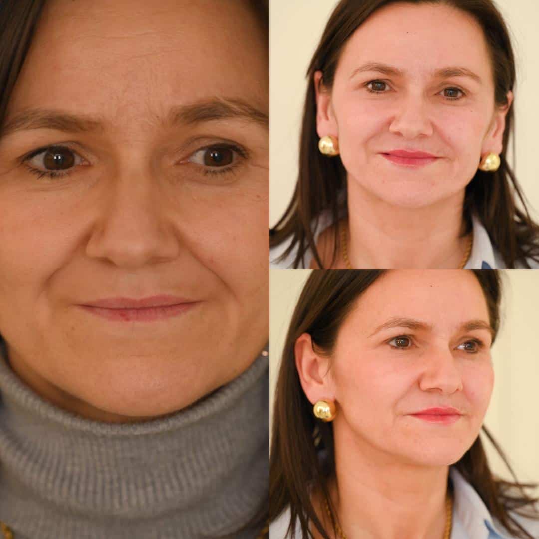 popunjavanje jagodica filerom